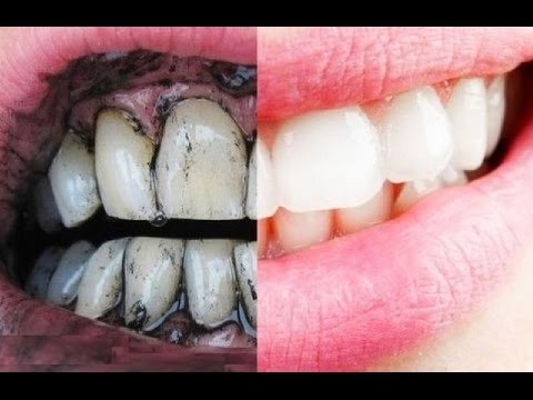 شاهد الطريقة السحرية لتبييض الأسنان بالملح