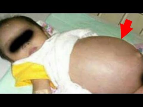 عملية جراحية لطفل صغير تكشف عن جنين داخل بطنه