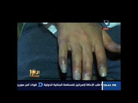 شاهد حقنة مخدرات تهدد شابًا بفقدان أحد ذراعيه