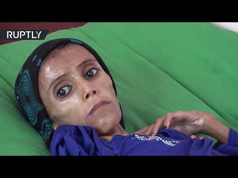 تأثير الجوع على طفلة يمنية عمرها 12 عامًا