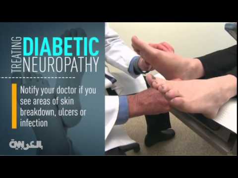 تجنب آثار السُكري عبر العناية بالقدمين بالفيديو
