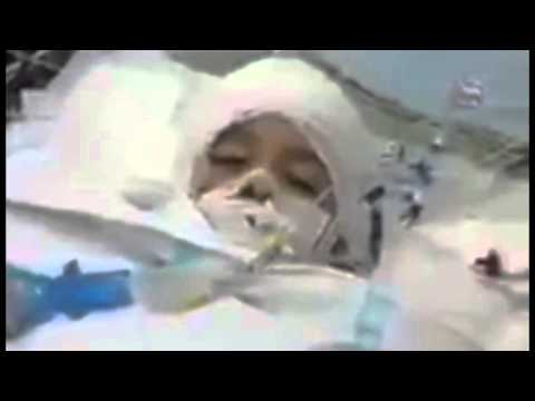 شاهد شقيق علي دوابشة يحاول فتح عينيه بين الحياة والموت