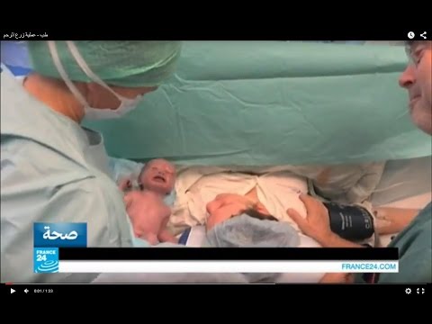 بالفيديو عملية لزرع الرحم في السويد