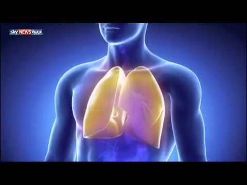 خلل جيني يؤدي لمرض التليف الكيسي