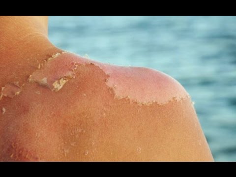 نصائح هامة لحماية البشرة في فصل الصيف