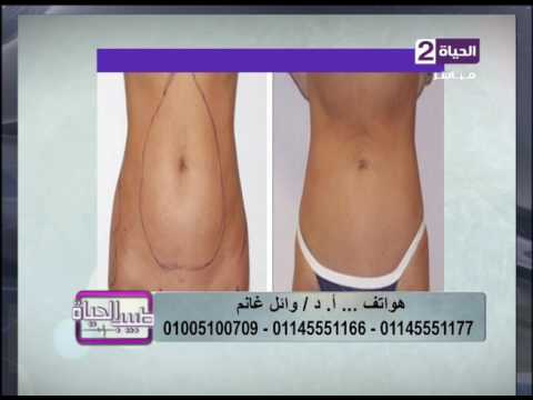 بالفيديو استشاري تجميل يُظهرنتائجًا مبهرة بعد شفط الدهون بالفيزر