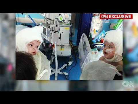 بالفيديو  رد فعل والدين لحظة رؤية توأمهما السيامي بعد فصلهما