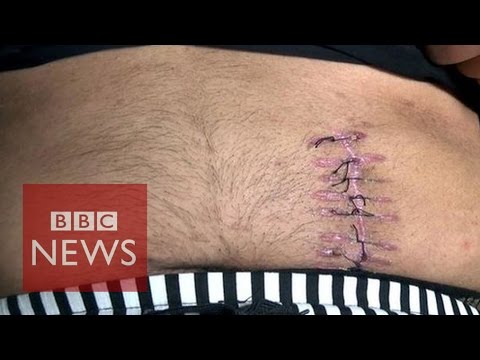 i sold my kidney for £4000